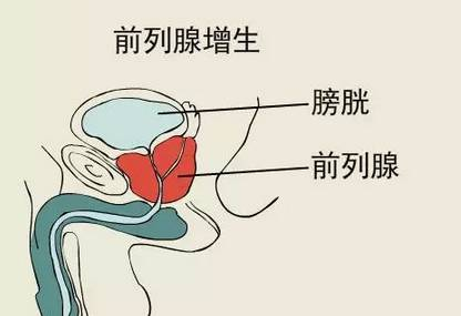 前列腺增生1.jpg