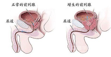 兰州前列腺增生的病因有哪些