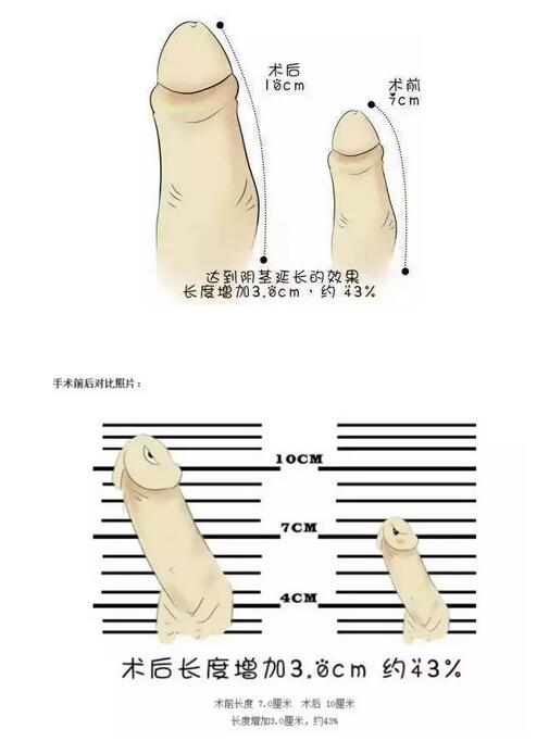 兰州阴茎延长手术